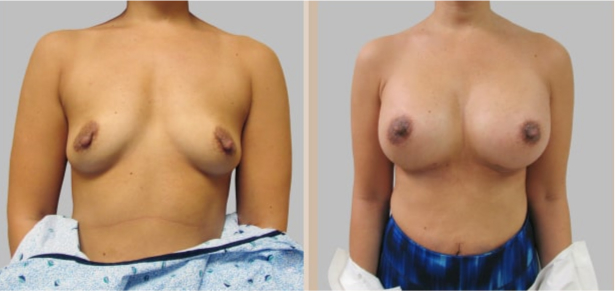 Before and After Image: Before and After Photos: Breast Augmentation (Breast Implants) - front