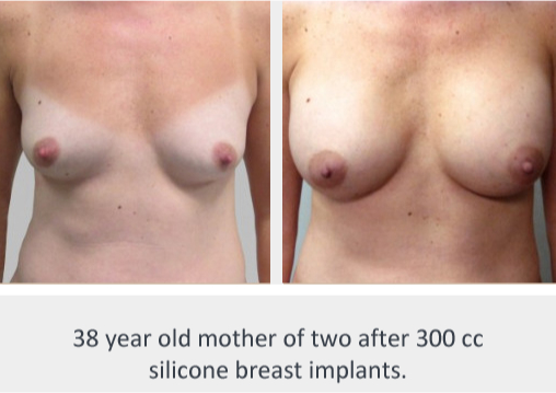 Before and After Image: Before and After Photos: Breast Augmentation (Breast Implants) - front