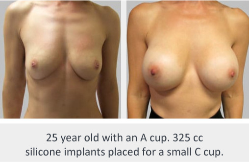 Before and After Image: Before and After Photos: Breast Augmentation (Breast Implants) - front