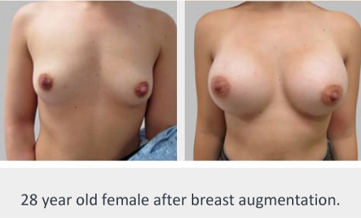 Before and After Image: Before and After Photos: Breast Augmentation (Breast Implants) - front