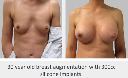 Before and After Image: Before and After Photos: Breast Augmentation (Breast Implants) - front