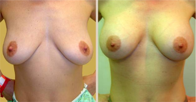 Before and After Image: Before and After Photos: Breast Augmentation (Breast Implants) - front