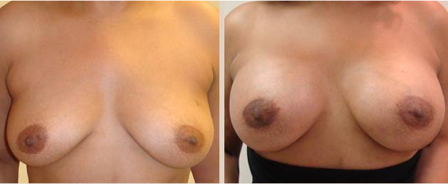 Before and After Image: Before and After Photos: Breast Augmentation (Breast Implants) - front