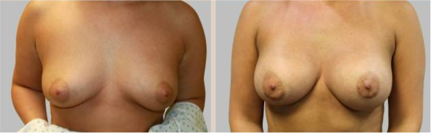 Before and After Image: Before and After Photos: Breast Augmentation (Breast Implants) - front
