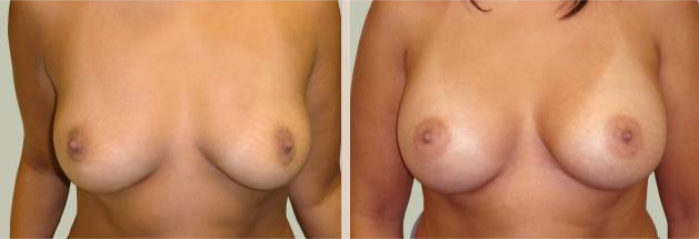 Before and After Image: Before and After Photos: Breast Augmentation (Breast Implants) - front