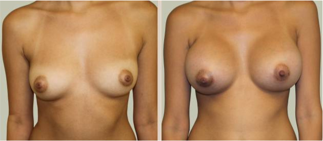 Before and After Image: Before and After Photos: Breast Augmentation (Breast Implants) - front