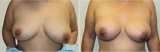 Before and After Image: Before and After Photos: Breast Augmentation (Breast Implants) - front