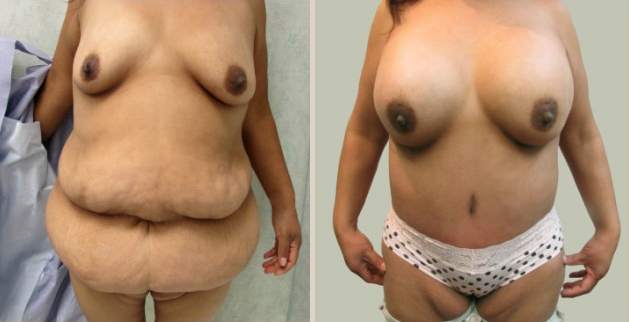 Before and After Image: Before and After Photos: Body Contouring After Weight Loss - front