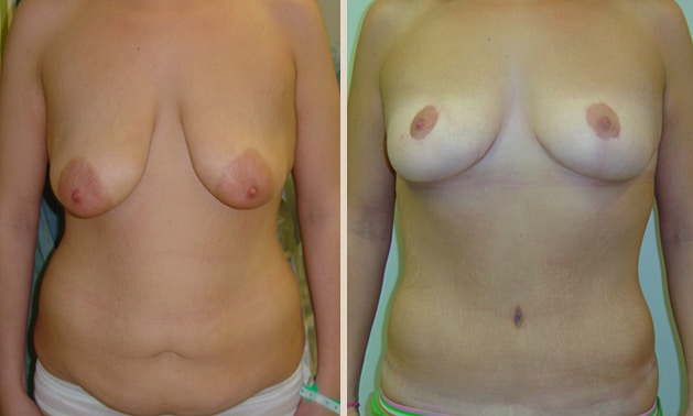 Before and After Image: Before and After Photos: Body Contouring After Weight Loss - front