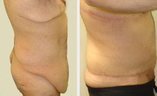 Before and After Image: Before and After Photos: Body Contouring After Weight Loss - right-side