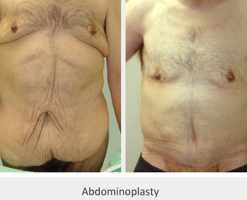 Before and After Image: Before and After Photos: Body Contouring After Weight Loss - front