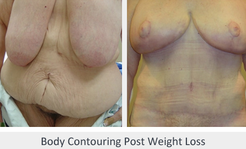 Before and After Image: Before and After Photos: Body Contouring After Weight Loss - front