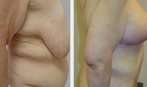 Before and After Image: Before and After Photos: Body Contouring After Weight Loss - right-side