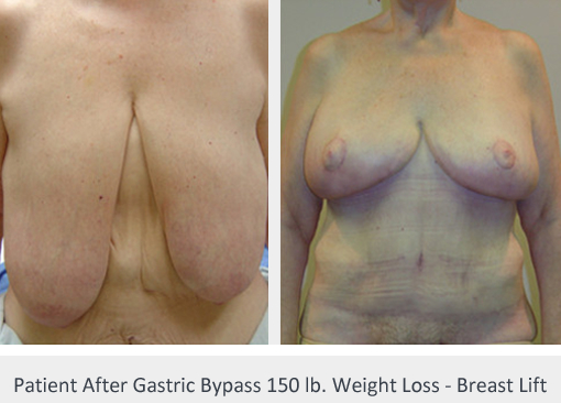 Before and After Image: Before and After Photos: Body Contouring After Weight Loss - front