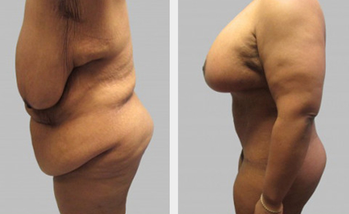 Before and After Image: Before and After Photos: Body Contouring After Weight Loss - left-side