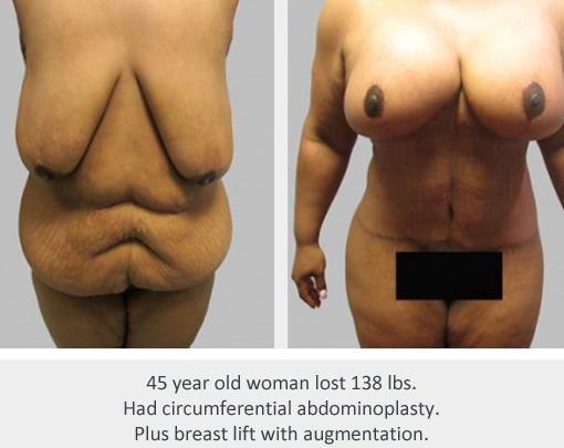 Before and After Image: Before and After Photos: Body Contouring After Weight Loss - front