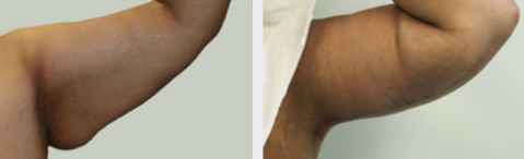 Before and After Image: Before and After Photos: Brachioplasty - front