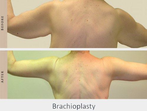 Before and After Image: Before and After Photos: Brachioplasty - back