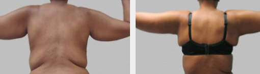 Before and After Image: Before and After Photos: Brachioplasty - back