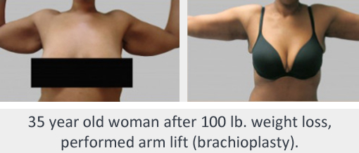 Before and After Image: Before and After Photos: Brachioplasty - front
