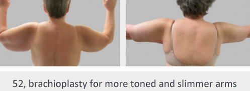 Before and After Image: Before and After Photos: Brachioplasty - front