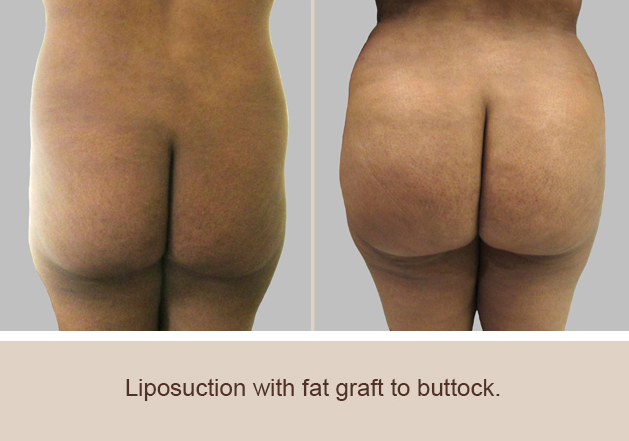 Before and After Image: Brazilian Butt Lift : Before & After Photos - back