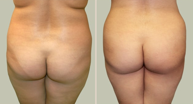Before and After Image: Brazilian Butt Lift : Before & After Photos - back