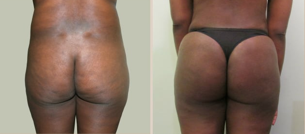 Before and After Image: Brazilian Butt Lift : Before & After Photos - back