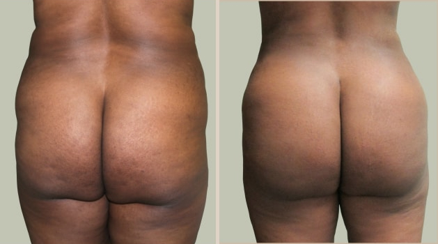 Before and After Image: Brazilian Butt Lift : Before & After Photos - back
