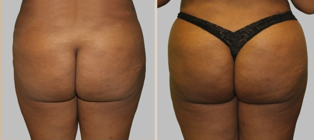 Before and After Image: Brazilian Butt Lift : Before & After Photos - back