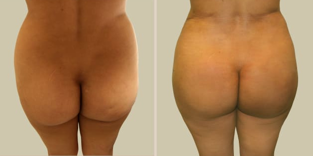Before and After Image: Brazilian Butt Lift : Before & After Photos - back