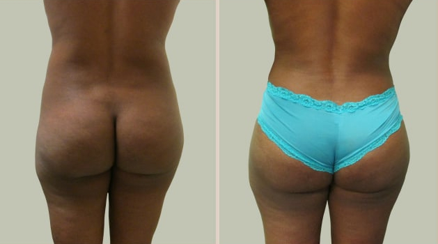 Before and After Image: Brazilian Butt Lift : Before & After Photos - back