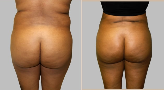 Before and After Image: Brazilian Butt Lift : Before & After Photos - back