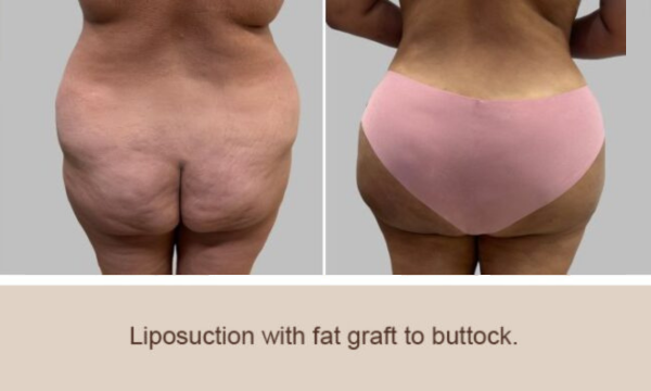 Before and After Image: Brazilian Butt Lift : Before & After Photos - back