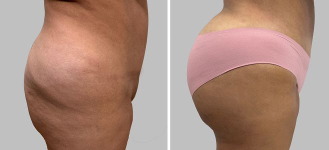 Before and After Image: Brazilian Butt Lift : Before & After Photos - right-side