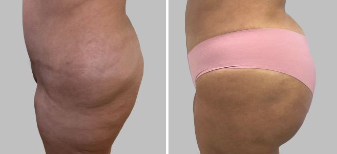 Before and After Image: Brazilian Butt Lift : Before & After Photos - left-side