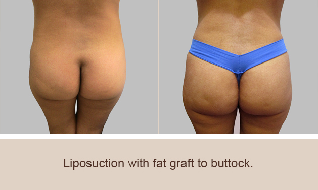 Before and After Image: Brazilian Butt Lift : Before & After Photos - back