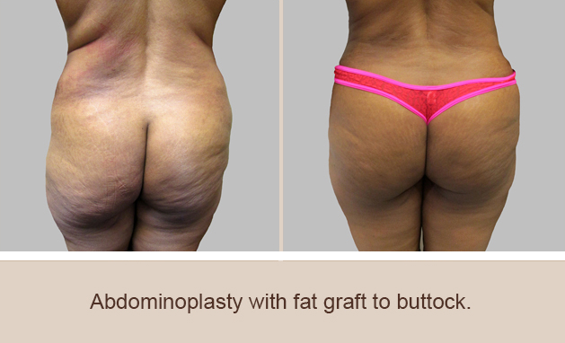 Before and After Image: Brazilian Butt Lift : Before & After Photos - back