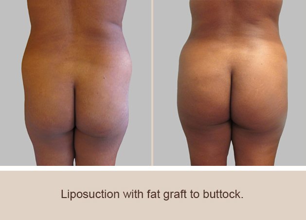 Before and After Image: Brazilian Butt Lift : Before & After Photos - back