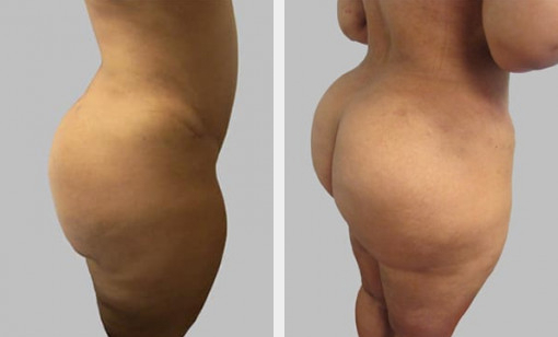 Before and After Image: Brazilian Butt Lift : Before & After Photos - right-side