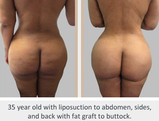 Before and After Image: Brazilian Butt Lift : Before & After Photos - back