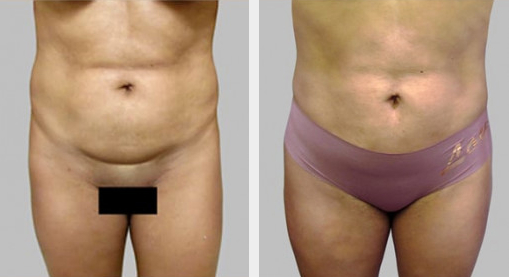 Before and After Image: Brazilian Butt Lift : Before & After Photos - front