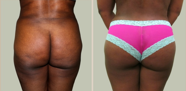 Before and After Image: Brazilian Butt Lift : Before & After Photos - back
