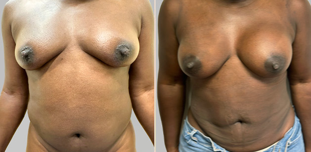 Before and After Image: Before and After Photos: Breast Augmentation and Lift - front