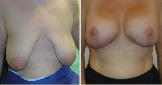 Before and After Image: Before and After Photos: Breast Augmentation and Lift - front