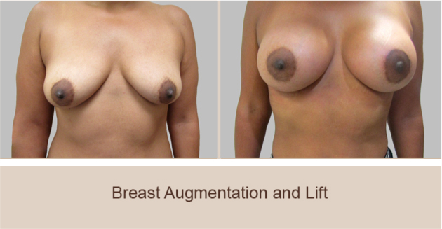 Before and After Image: Before and After Photos: Breast Augmentation and Lift - front
