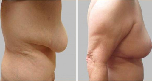 Before and After Image: Before and After Photos: Breast Augmentation and Lift - right-side