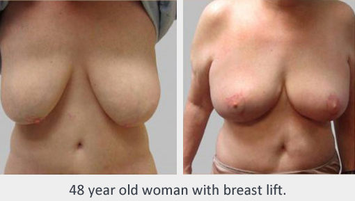 Before and After Image: Before and After Photos: Breast Augmentation and Lift - front