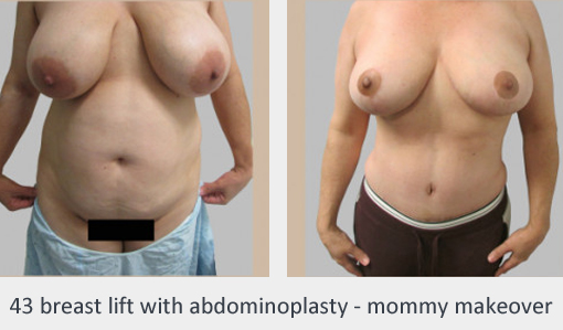 Before and After Image: Before and After Photos: Breast Augmentation and Lift - right-side