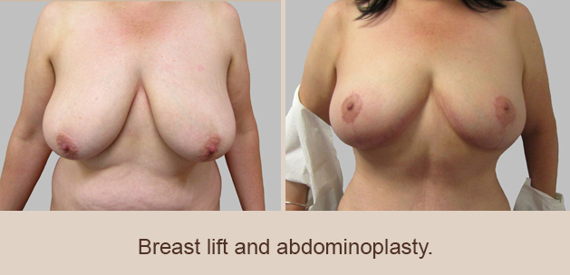 Before and After Image: Before and After Photos: Breast Augmentation and Lift - front